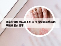 寻常型银屑病红斑不脱皮 寻常型银屑病红斑不脱皮怎么回事