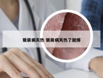 银屑病天热 银屑病天热了就痒