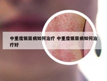 中重度银屑病如何治疗 中重度银屑病如何治疗好