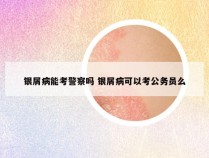 银屑病能考警察吗 银屑病可以考公务员么