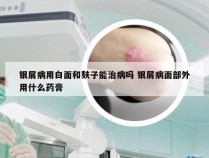 银屑病用白面和麸子能治病吗 银屑病面部外用什么药膏