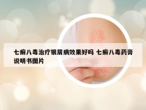 七癣八毒治疗银屑病效果好吗 七癣八毒药膏说明书图片