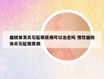 扁桃体发炎引起银屑病可以治愈吗 慢性扁桃体炎引起银屑病