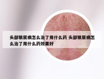 头部银屑病怎么治了用什么药 头部银屑病怎么治了用什么药效果好