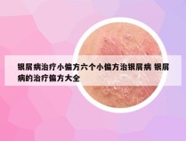 银屑病治疗小偏方六个小偏方治银屑病 银屑病的治疗偏方大全