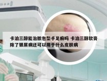 卡泊三醇能治脓包型手足癣吗 卡泊三醇软膏除了银屑病还可以用于什么皮肤病