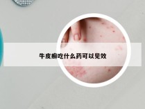 牛皮癣吃什么药可以见效