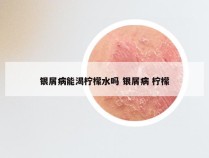 银屑病能渴柠檬水吗 银屑病 柠檬