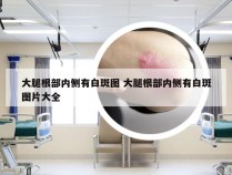 大腿根部内侧有白斑图 大腿根部内侧有白斑图片大全