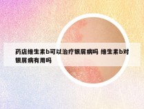 药店维生素b可以治疗银屑病吗 维生素b对银屑病有用吗