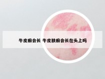 牛皮癣会长 牛皮肤癣会长在头上吗