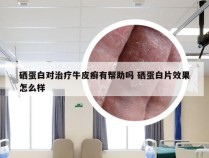 硒蛋白对治疗牛皮癣有帮助吗 硒蛋白片效果怎么样