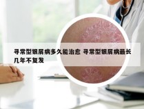 寻常型银屑病多久能治愈 寻常型银屑病最长几年不复发