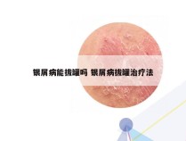 银屑病能拔罐吗 银屑病拔罐治疗法