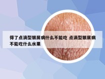 得了点滴型银屑病什么不能吃 点滴型银屑病不能吃什么水果