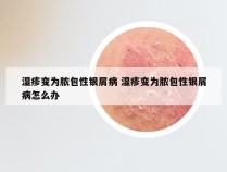 湿疹变为脓包性银屑病 湿疹变为脓包性银屑病怎么办