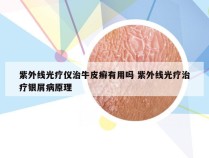 紫外线光疗仪治牛皮癣有用吗 紫外线光疗治疗银屑病原理