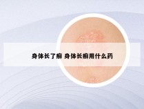 身体长了癣 身体长癣用什么药