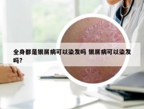 全身都是银屑病可以染发吗 银屑病可以染发吗?