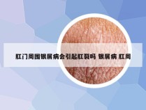 肛门周围银屑病会引起肛裂吗 银屑病 肛周