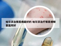 哈尔滨治银屑病最好的 哈尔滨治疗银屑病哪里医院好