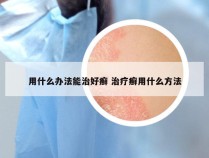 用什么办法能治好癣 治疗癣用什么方法