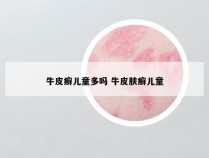 牛皮癣儿童多吗 牛皮肤癣儿童