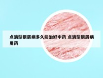 点滴型银屑病多久能治好中药 点滴型银屑病用药