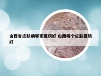 山西省皮肤病哪家医院好 山西哪个皮肤医院好