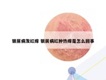 银屑病发红痒 银屑病红肿热痒是怎么回事