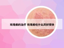 玫瑰癣的治疗 玫瑰癣吃什么药好得快