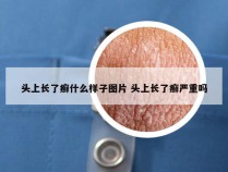 头上长了癣什么样子图片 头上长了癣严重吗