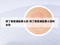 得了银屑病能要小孩 得了银屑病能要小孩吗女性