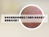 身体长癣是身体哪里出了问题吗 身体长癣了是哪里出问题了