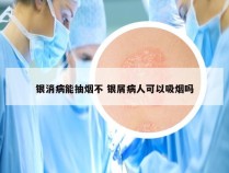 银消病能抽烟不 银屑病人可以吸烟吗