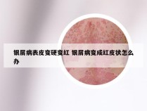 银屑病表皮变硬变红 银屑病变成红皮状怎么办