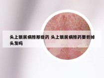 头上银屑病擦那些药 头上银屑病擦药要剪掉头发吗