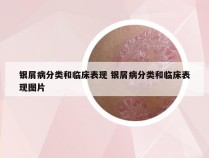 银屑病分类和临床表现 银屑病分类和临床表现图片