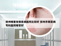 郑州哪里有银屑病医院比较好 郑州市银屑病专科医院哪家好