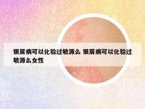 银屑病可以化验过敏源么 银屑病可以化验过敏源么女性