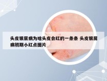 头皮银屑病为啥头皮会红的一条条 头皮银屑病初期小红点图片