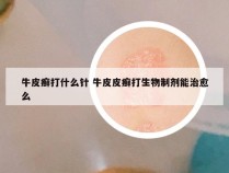 牛皮癣打什么针 牛皮皮癣打生物制剂能治愈么