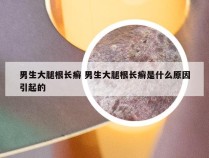 男生大腿根长癣 男生大腿根长癣是什么原因引起的