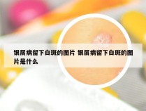 银屑病留下白斑的图片 银屑病留下白斑的图片是什么