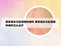 银屑病会引起咽喉肿痛吗 银屑病会引起咽喉肿痛吗怎么治疗