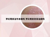 罗红霉素治牛皮癣吗 罗红霉素软膏治癣吗