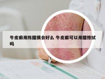 牛皮癣用陈醋摸会好么 牛皮廨可以用醋擦拭吗