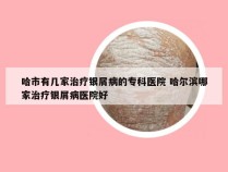 哈市有几家治疗银屑病的专科医院 哈尔滨哪家治疗银屑病医院好