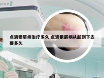 点滴银屑病治疗多久 点滴银屑病从起到下去要多久