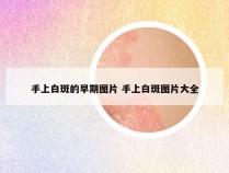 手上白斑的早期图片 手上白斑图片大全